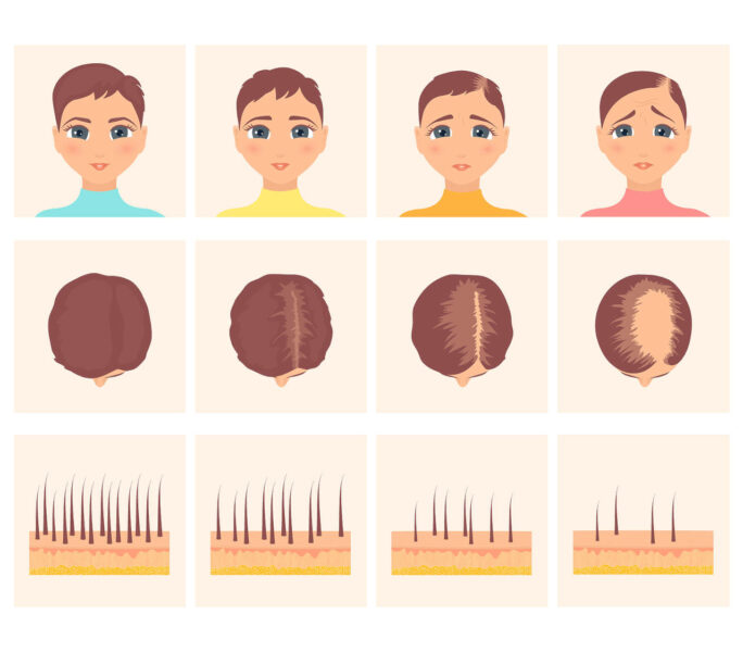 Woman before and after hair loss treatment in front and top view