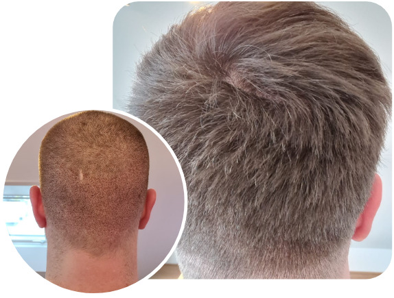 Patient after an Elithair FUE hair transplant technique with 3100 grafts