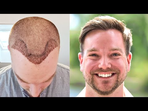 homepage before after video Elithair patient 3 thumbnail