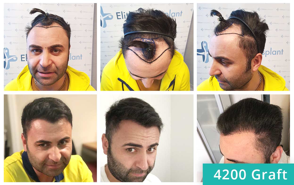 Thumbnail before and after sapphire and percutaneous hair transplant of Murat Kizilkaya