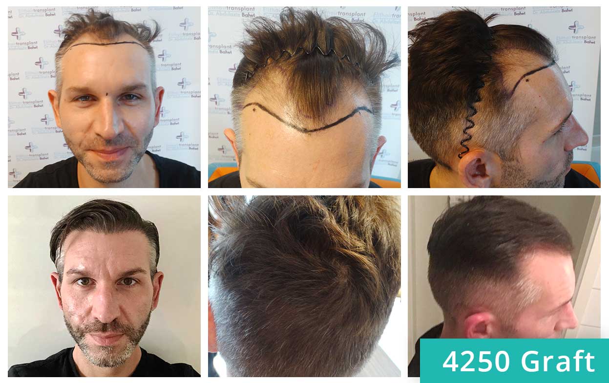 Thumbnail before and after the sapphire hair transplant of Thomas Schreier