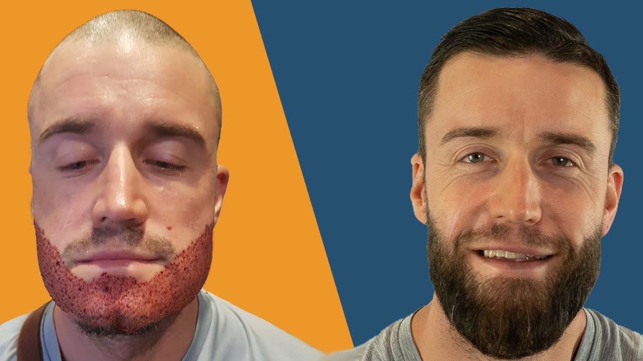 video thumbnail 1 of a beard patient
