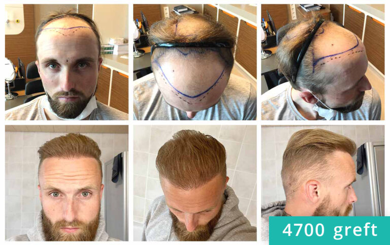 Before-after-hair-transplant-mr-fredrick